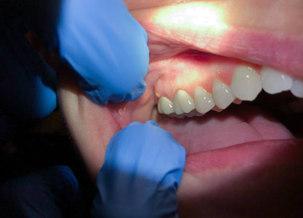 Best Broken or Cracked Tooth Emergency Dentist in Parkway, CA